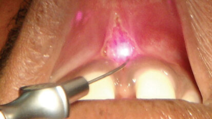 Frenektomie – Srovnání konvenčních technik a diodového laseru