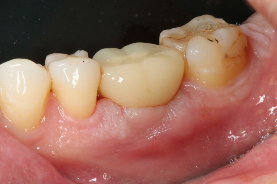 Fig. 14: Provisional crown seated.