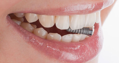 Teilimplantate für TGKK-Mitglieder