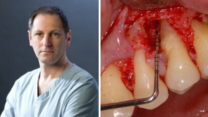 Terapia rigenerativa di un difetto infraosseo con approccio mini invasivo