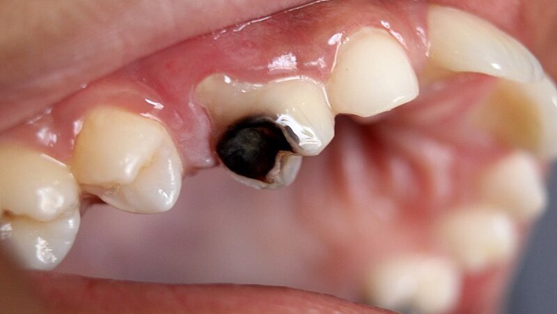 Editorial: Can we rebuild the lost enamel?