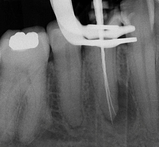Fig. 6: Working length radiograph.