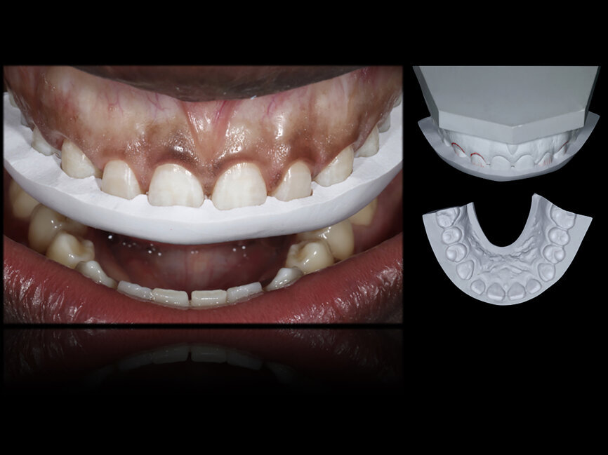 Fig. 58: Laboratory prepared silicone key adapted to the clinical calibrated preparation.