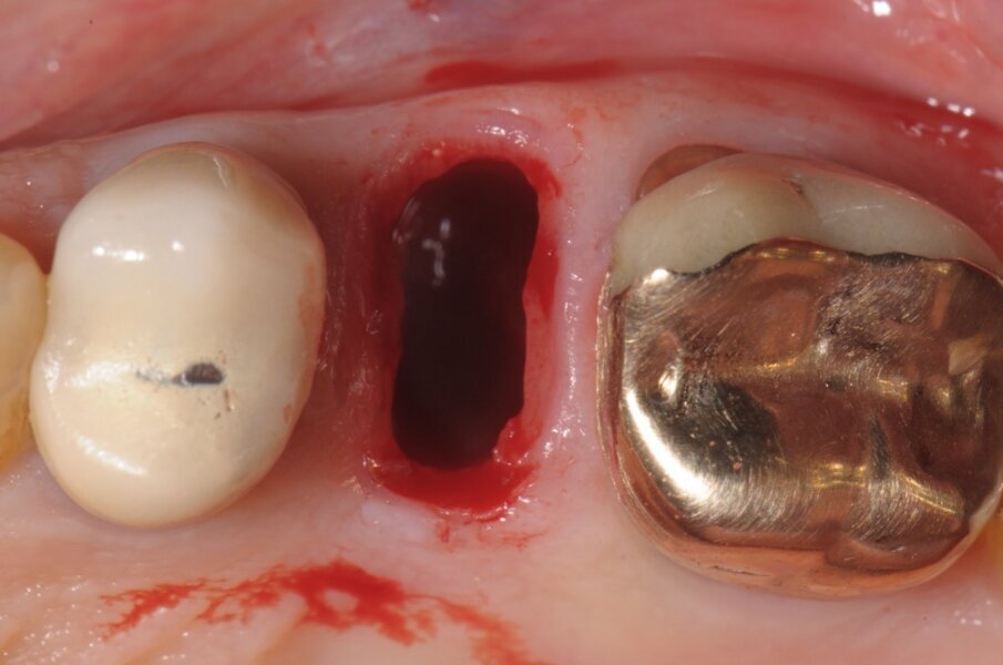 Fig. 3 - Visione occlusale del sito estrattivo nella fase immediatamente successiva la rimozione radicolare.