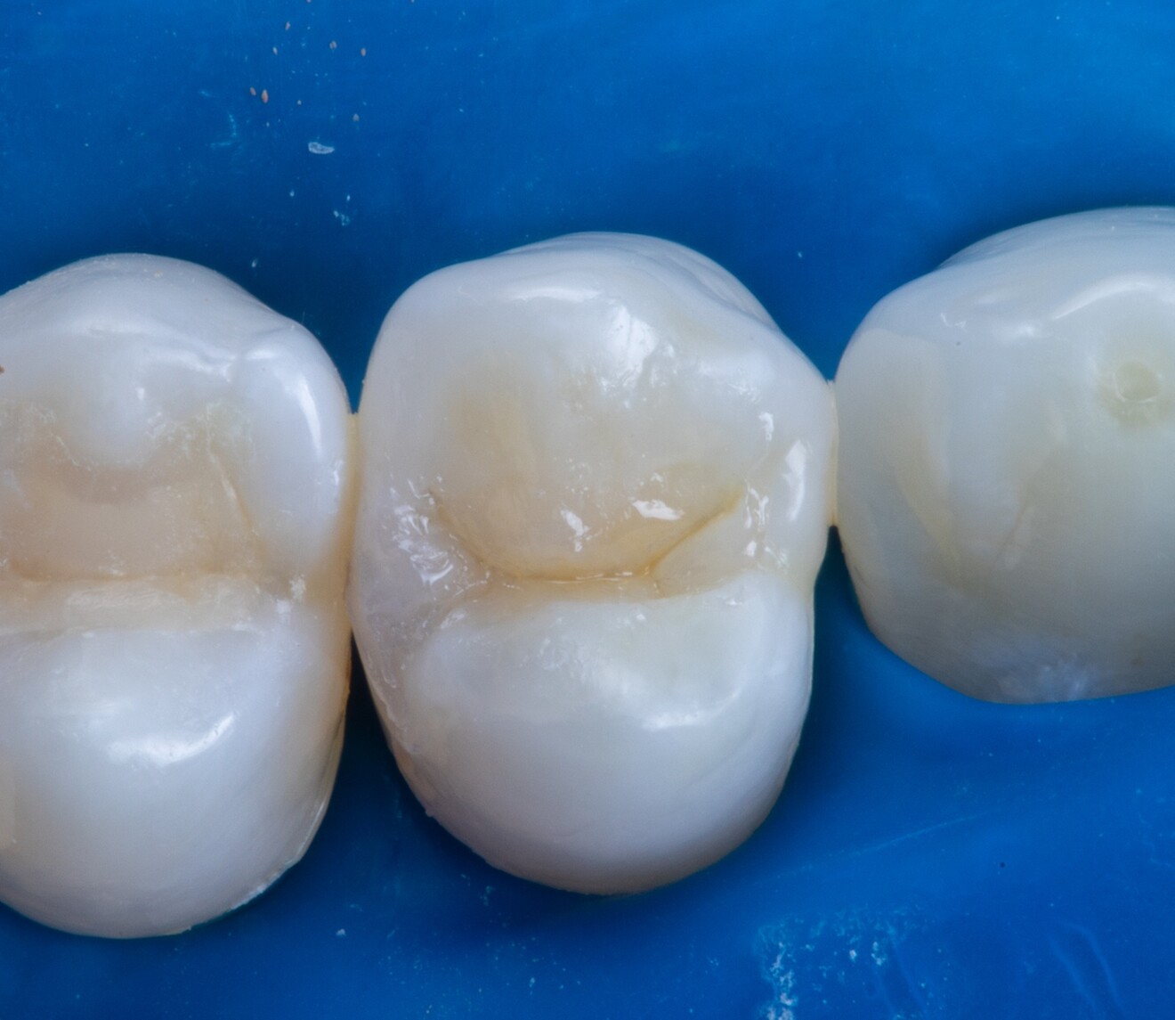 Fig. 1d: Composite build-up.