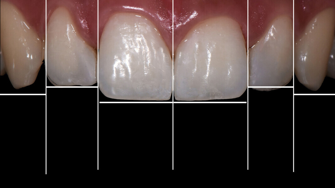 Fig. 20: Aesthetic result achieved.