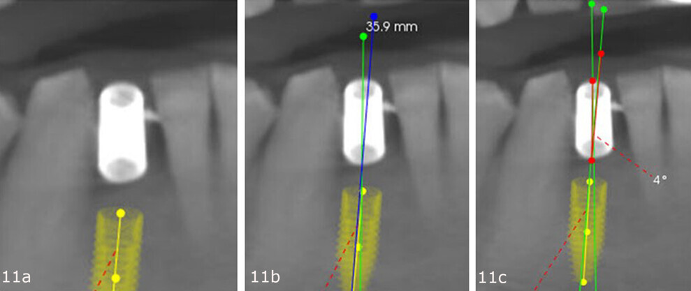 Figs. 11a–c: Mesiodistal positioning of the virtual planned implant in the planning software (a). Virtual planned implant position (blue line) in relation to the guide sleeve (green line; b) in the mesiodistal dimension, requiring a 4° angle correction (red line; c).