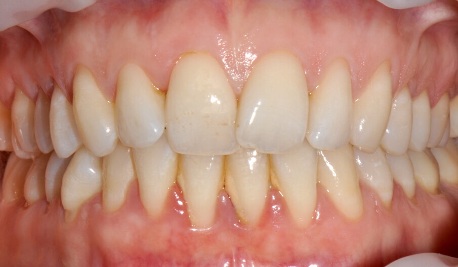 Figg. 4a-4f - Confronto fra inizio e termine della terapia. Le immagini (4a-c) mostrano le aree vestibolare palatale e linguale prima della terapia, mentre le immagini (4d-f) mostrano le aree vestibolare palatale e linguale dopo della terapia.