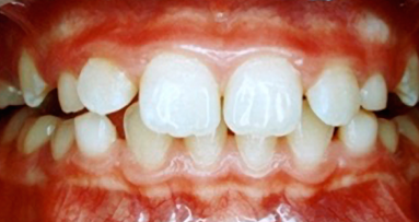 Evolución del tratamiento miofuncional postural con los sistemas de MRC (3)