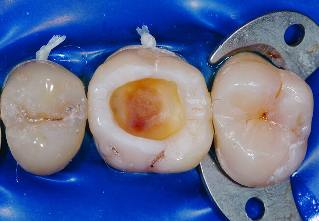 Fig. 19: Apres rinçage et séchage doux (sans provoquer une déshydratation accrue de la dentine) l’email apparait blanc crayeux signe d’une efficacité de l’agent de mordançage. 