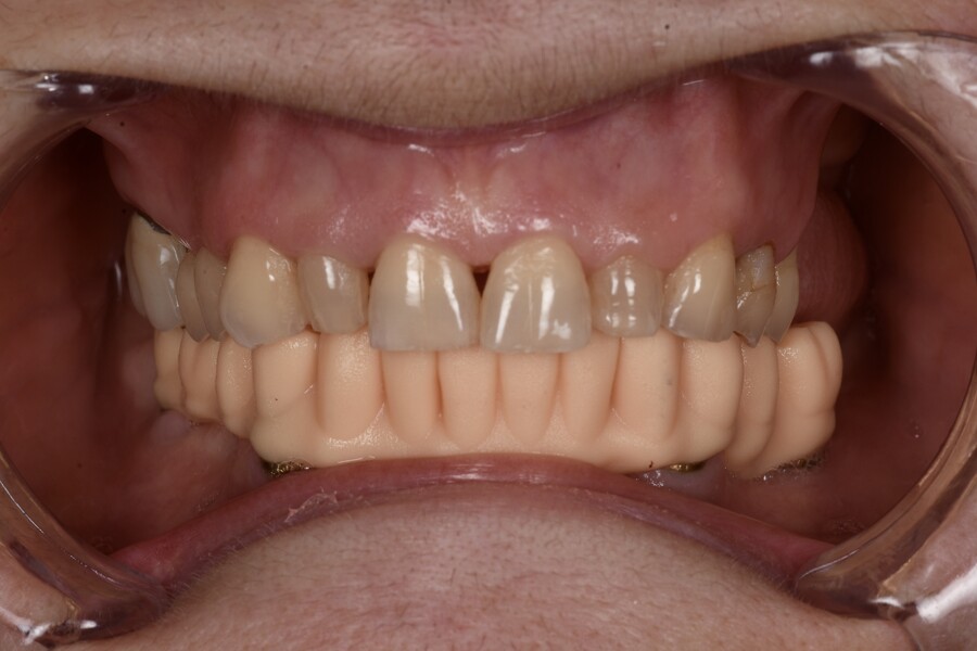 Fig. 14: 3D-printed diagnostic prosthesis.
