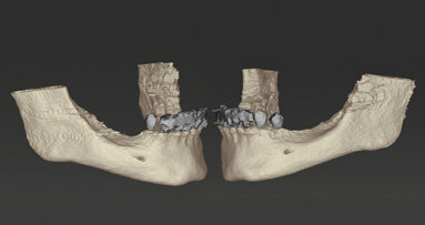Riabilitazione di una mandibola atrofica con programmazione 3D