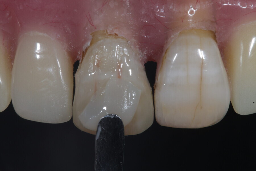 Fig. 18: The enamel layer (Estelite) is applied.
