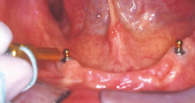 Soluzioni per attacchi