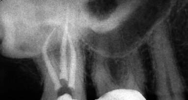 Secrets to better, safer, easier and far less costly endodontics