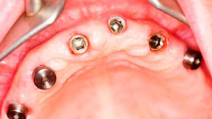 Anche nei pazienti diabetici gli impianti possono avere un buon successo