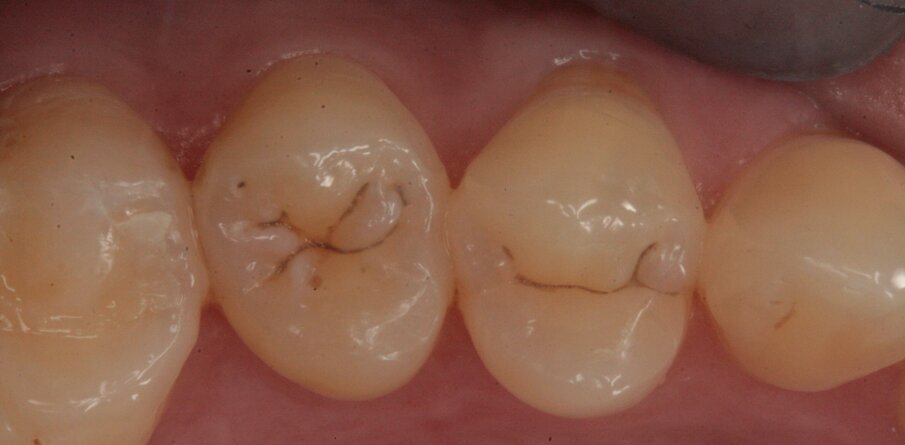 Fig. 9_Elementi 14 e 15 interessati da lesione cariosa.