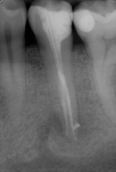 Fig. 7a: Radiographic follow-up. Radiograph after three months.