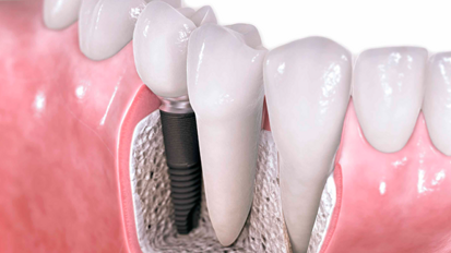 Implantatinnovation aus Mexiko