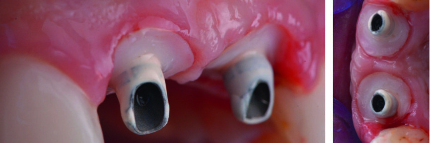 Fig. 24 : Vue des piliers provisoires après une période de cicatrisation de six mois