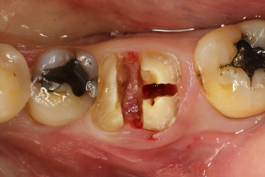 Fig. 4: Root splitting for minimally traumatic extraction.