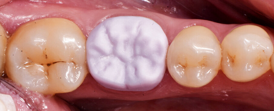 Figs. 3a&b: Crown design in the software suite (inLab) and try-in before crystallisation firing (IPS e.max CAD).