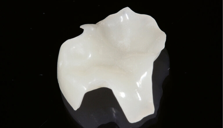 Fig. 6: Restoration after high-gloss polishing