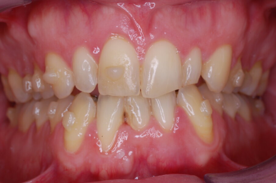 Figg. 45-50_Fotografie intraorali frontali in sequenza che illustrano il progressivo livellamento e allineamento e il raddrizzamento dell’incisivo laterale mandibolare destro.