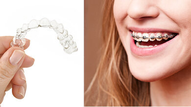 Studie zjistila, že jsou průhledná snímatelná rovnátka prospěšnější než fixní rovnátka