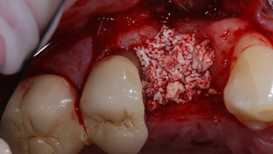 La gestione dell’alveolo estrattivo nel trattamento implantare alla luce delle più recenti acquisizioni