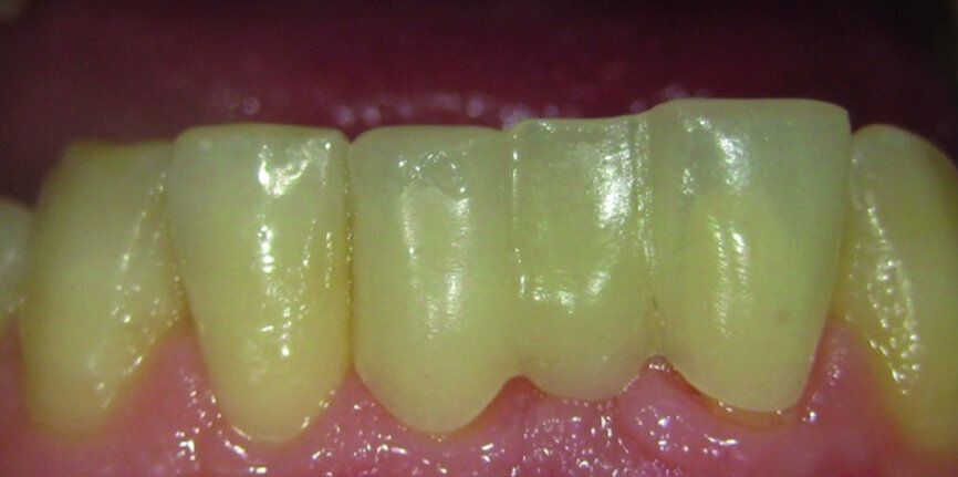 Fig. 12: Trial of temporary bridge,
milled with PMMA Tempomill Vario (ZMT).