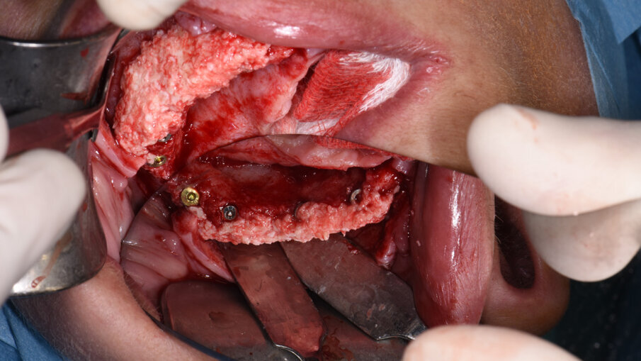 Obr. 8a, b: Druhá horizontální augmentace na pravé straně (a) a na levé straně (b) s již zavedenými implantáty.