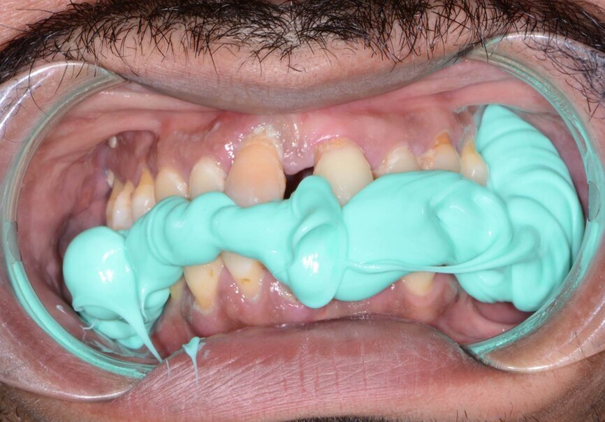 Fig. 4: Pre-op bite registration with Futar.