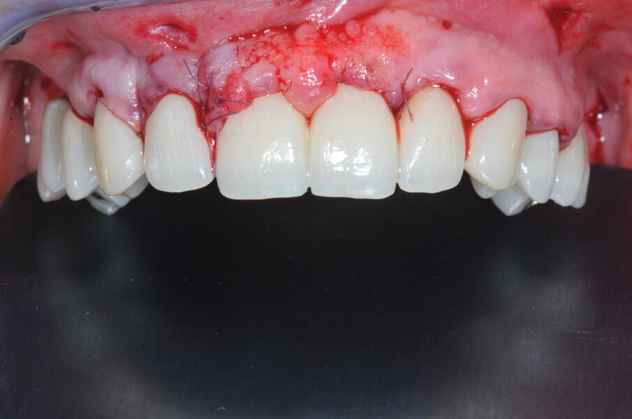 Fig. 4b_Protesi provvisoria a carico immediato.
