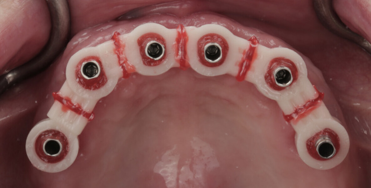 Fig. 18: Verification jig re-luted intra-orally.