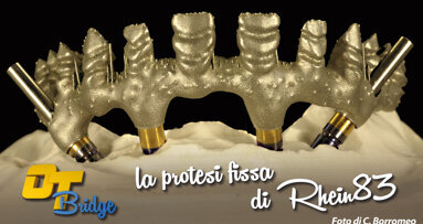 OT BRIDGE: la protesi fissa secondo la Rhein83