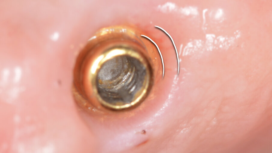 Fig. 15_Ottimo stato di salute di OT Bridge allo smontaggio della vite di guarigione.