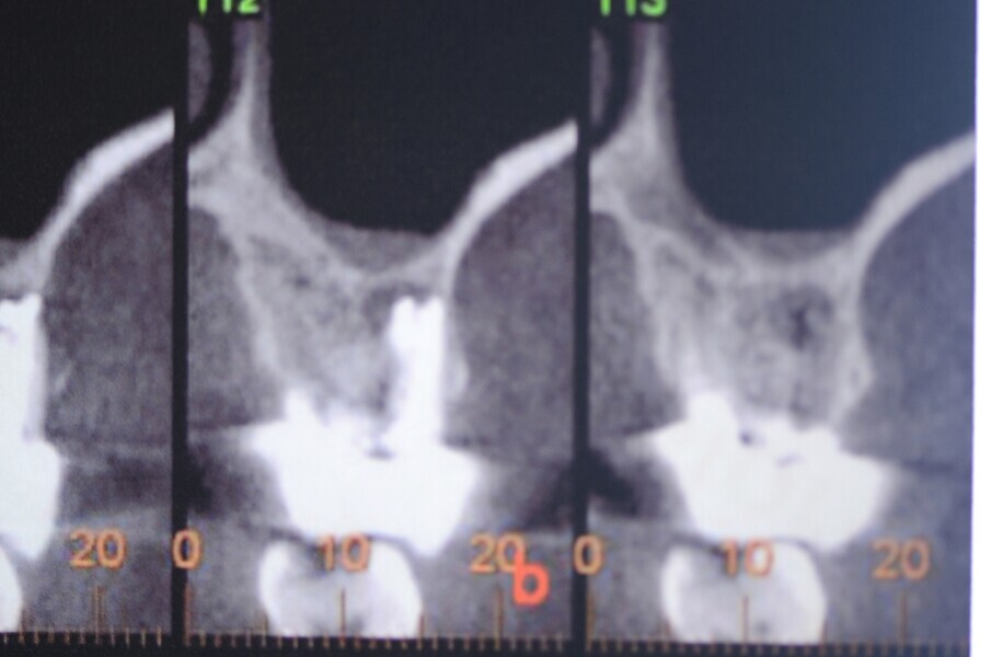 Fig. 2 : Radiographie avant l’extraction (première phase).