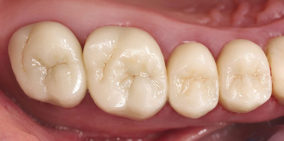 Fig. 11: Situation after ten years (2017): The crowns are intact and do not show any visible signs of damage. Abrasion facets can be observed, e.g. on the bucco-distal cusps of the upper left 6.