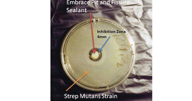Pulpdent Embrace Pit and Fissure Sealant