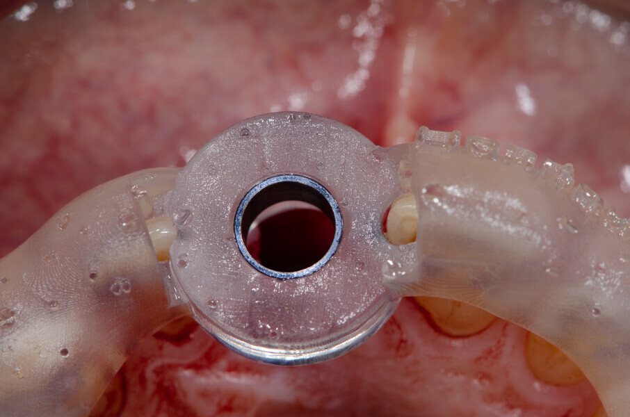 Fig. 13b: Surgical guide in place in the mouth, occlusal view.