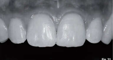 Anatomic stratification technique for lifelike anterior composites