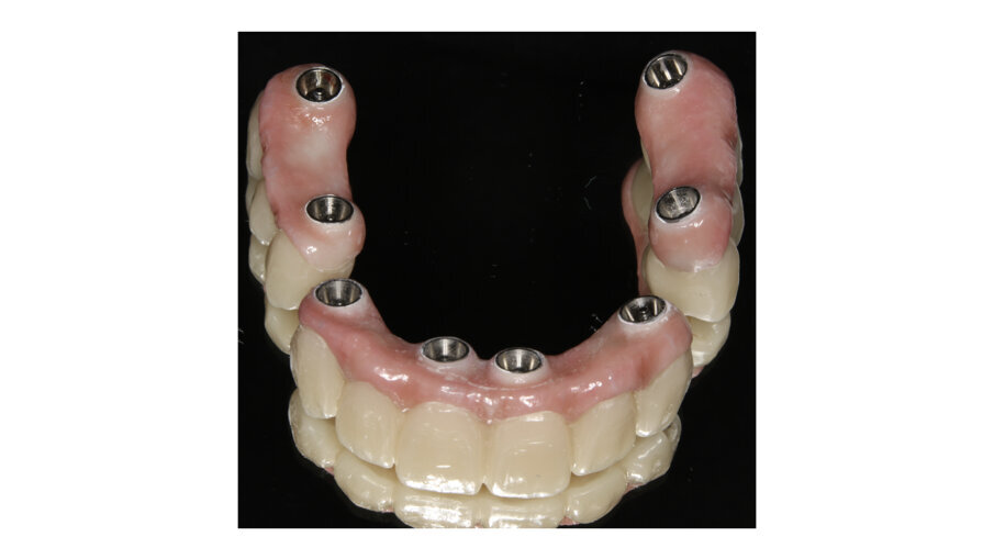 Fig. 7: Zirconia bridges ready to be screwed.