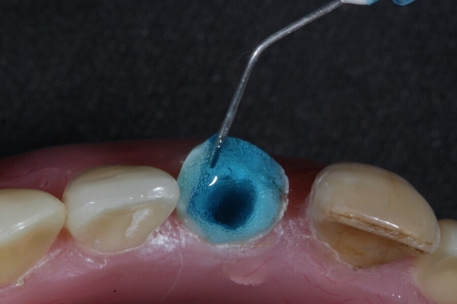 Fig. 4: Tooth #11 is etched after removal of two-thirds of the gutta-percha.