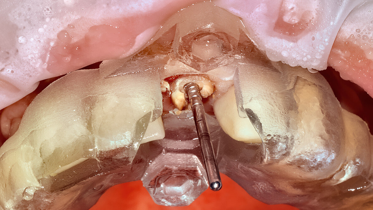 Guided applications for partial extraction therapy