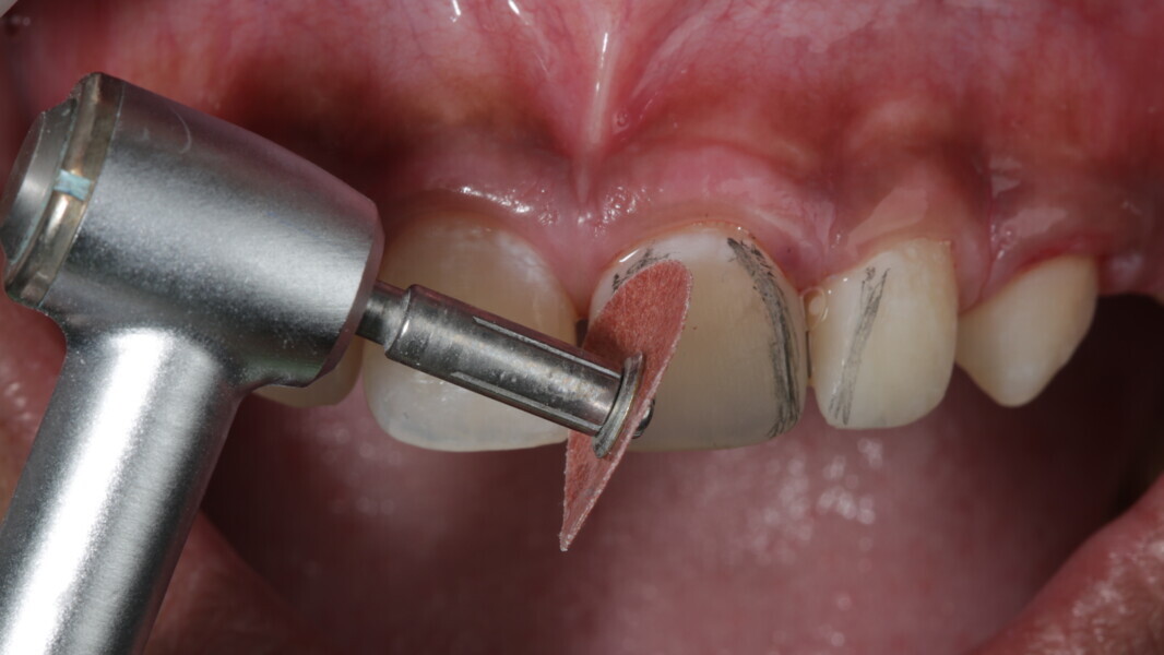 Fig 32: Sof-Lex finishing coarse disc was used to define the mesial and distal line angle at slow speed without irrigation.