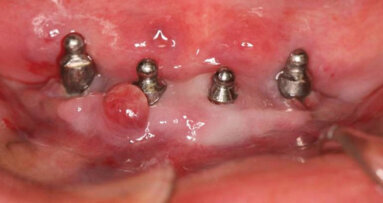 Péri-implantites et laser Er:YAG