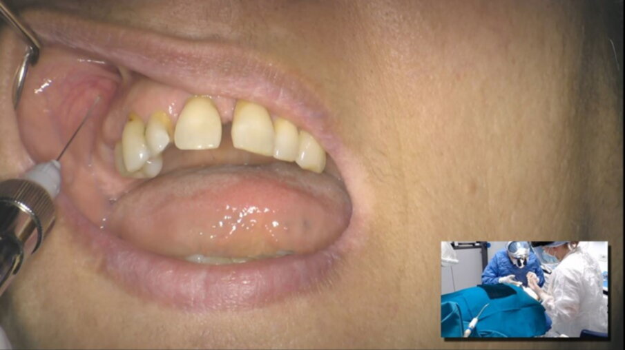 Figg. 45, 46_Implantologia chirurgica guidata.