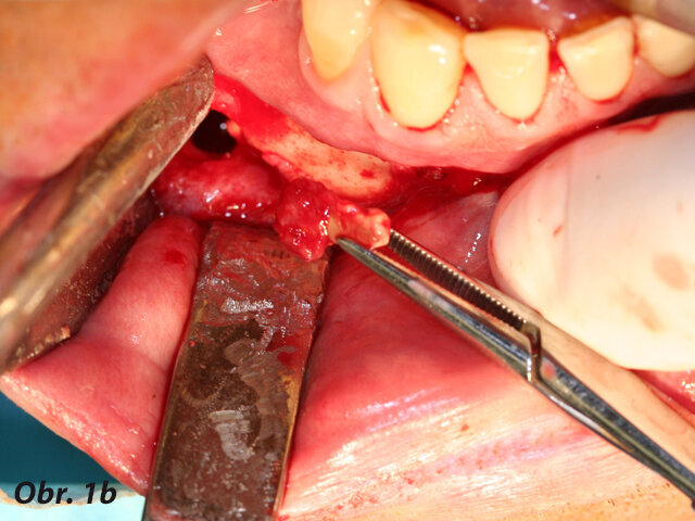 Vyjmutí kořene z rány