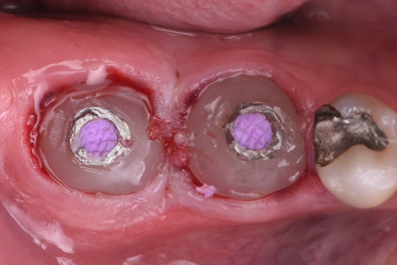 Fig. 11: Custom healing abutments placed. 